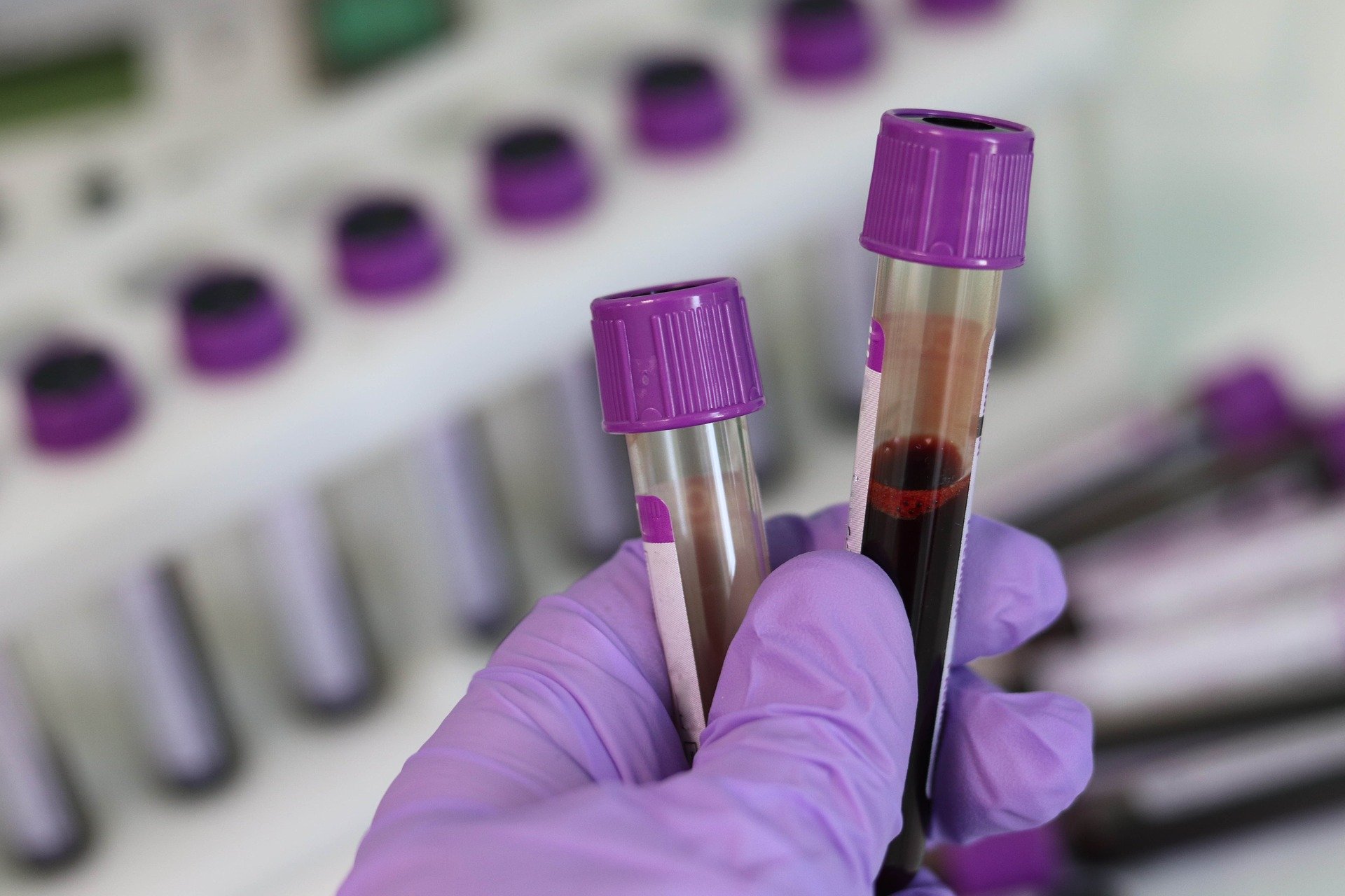 Premium Photo  Express covid-19 test for igm and igg antibodies to novel  coronavirus sars-cov-2, covid-19. nurse hand in glove collects patient  blood with disposable pipette. purple neon background.